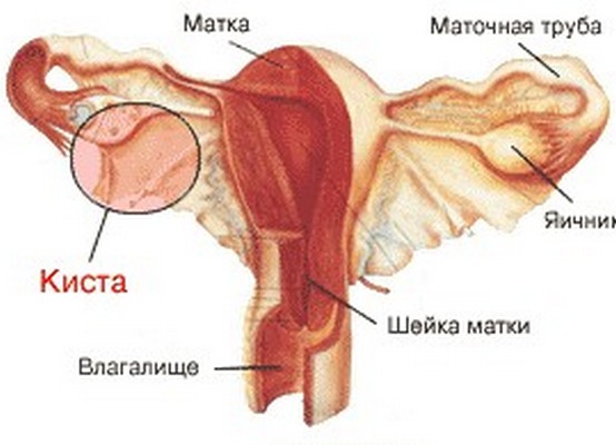 Эффективное лечение кисты матки Лечение кисты матки