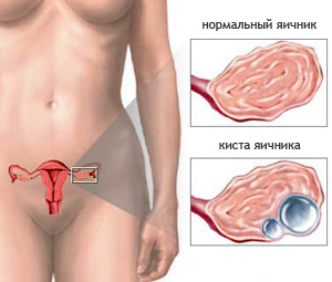 Лапароскопия кисты яичника - диагностика, лечение Лапароскопия кисты яичника