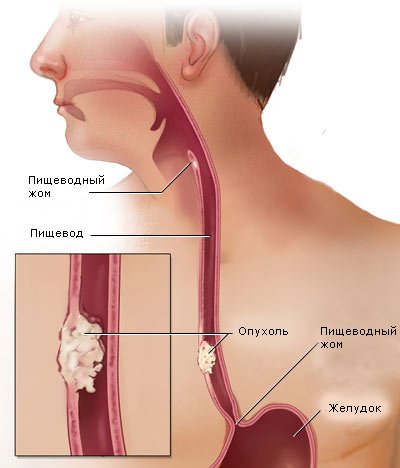 Лечение рака пищевода рак пищевода