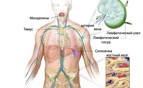 Лечение лимфомы Ходжкина Лимфома Ходжкина