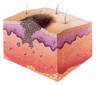 Меланома кожи лечение