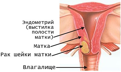 Онкология шейки матки Рак шейки матки лечение
