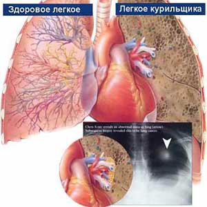 Методы лечения рака легких Рак легких лечение