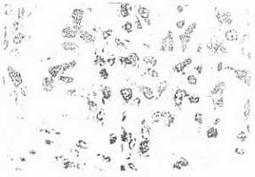 Пигментсодержащие клетки в контрольных препаратах меланомы В-16. Ув.900х. Окраска гематоксилином по Караччи.