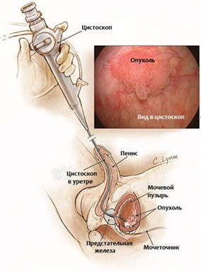 Рак мочевого пузыря лечение