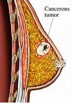 рак грудь анатомия фото