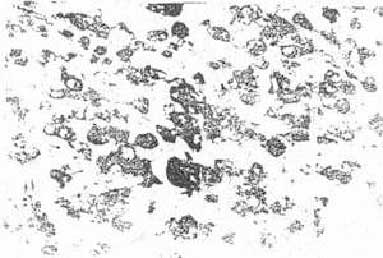Микрофотоинтактной меланомы В-16. Полиморфные клетки располагаются сплошным слоем. Ув.900х. Окраска гематоксилином по Караччи.